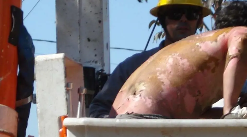 Espalda de un trabajador con extensas quemaduras