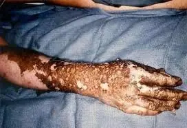 Mano y antebrazo con quemaduras profundas